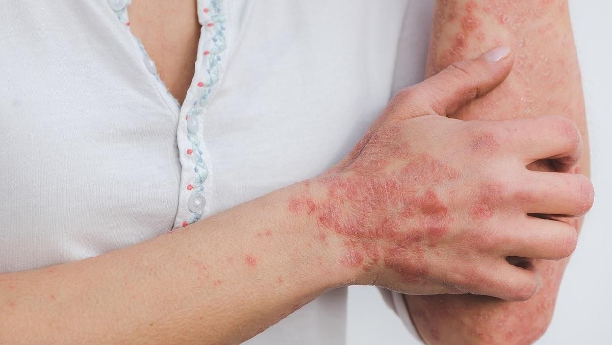 Псоріазом можна заразитись: міфи про шкірне захворювання - Здорово